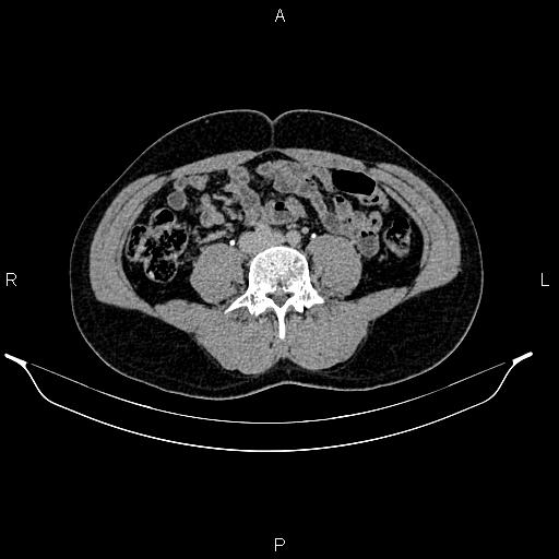 Adrenal myelolipoma (Radiopaedia 87794-104246 Axial renal excretory phase 62).jpg