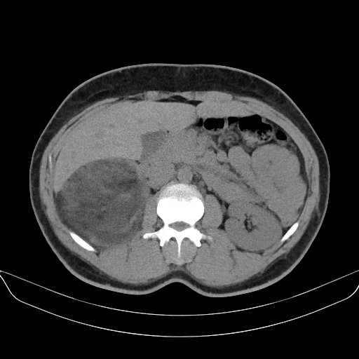 Adrenal myelolipoma - bilateral (Radiopaedia 74805-85810 Axial non-contrast 30).jpg
