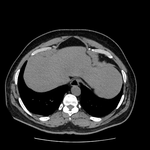 Adrenal myelolipoma and beaver tail liver (Radiopaedia 86201-102193 Axial non-contrast 52).jpg