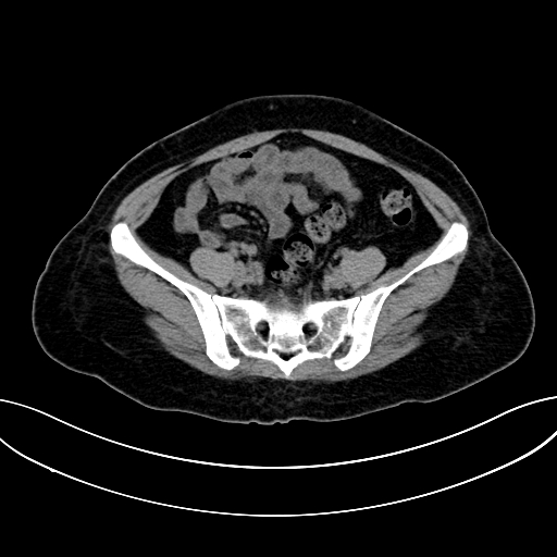 Adrenocortical carcinoma (Radiopaedia 87281-103569 Axial non-contrast 66).jpg
