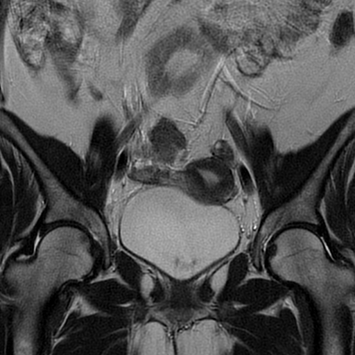 File:Adult granulosa cell tumor of the ovary (Radiopaedia 64991-73953 Coronal T2 10).jpg