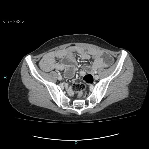 Adult transient intestinal intussusception (Radiopaedia 34853-36310 Axial C+ portal venous phase 84).jpg