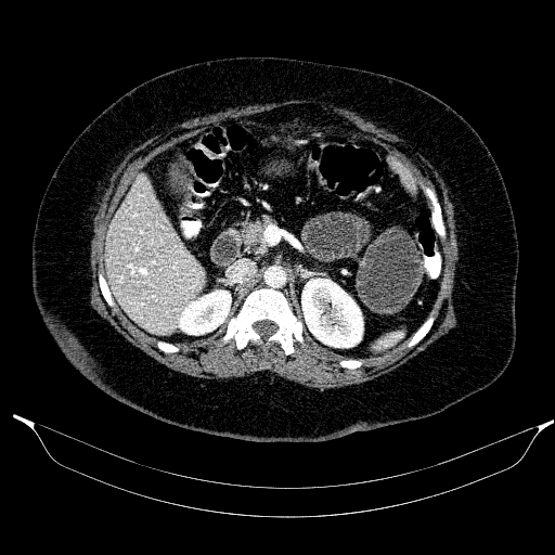 Afferent loop syndrome - secondary to incarcerated trocar site hernia (Radiopaedia 82959-97305 Axial C+ portal venous phase 82).jpg