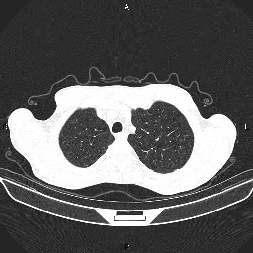 Air bronchogram in pneumonia (Radiopaedia 85719-101512 Axial lung window 13).jpg