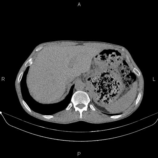 Air bronchogram in pneumonia (Radiopaedia 85719-101512 Axial non-contrast 65).jpg