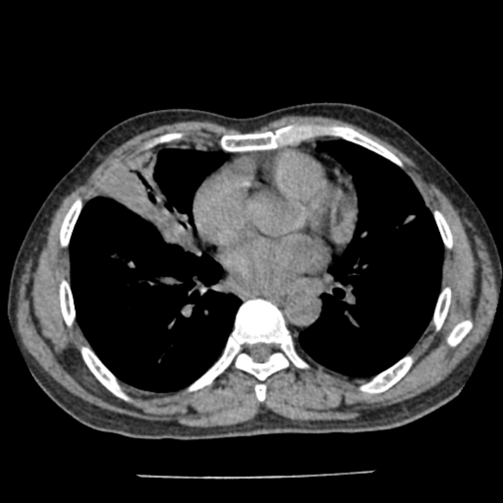 Airway foreign body in adult (Radiopaedia 85907-101779 Axial liver window 110).jpg