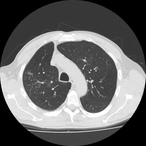 Allergic bronchopulmonary aspergillosis (ABPA) (Radiopaedia 60594-68313 Axial lung window 16).jpg