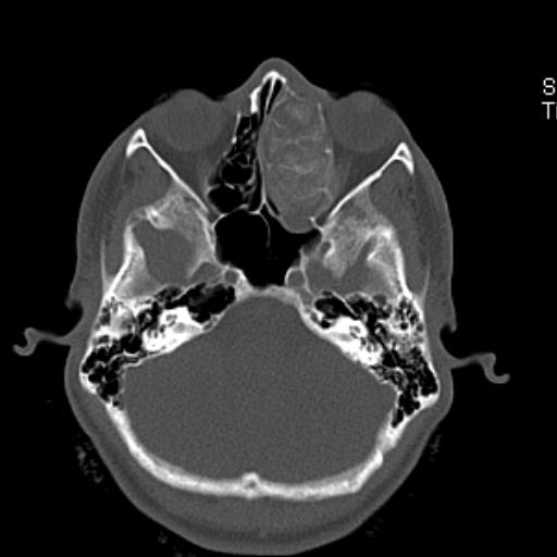 File:Allergic fungal sinusitis (Radiopaedia 29086-29455 Axial bone window 10).jpg