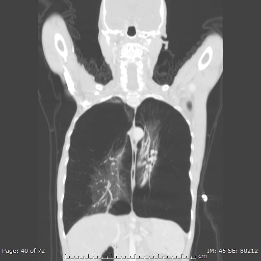 Alpha-1-antitrypsin deficiency (Radiopaedia 50561-55987 Coronal lung window 38).jpg