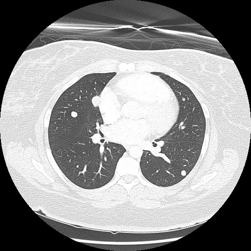 Alveolar soft part sarcoma - right leg (Radiopaedia 59432-67091 Axial lung window 58).jpg