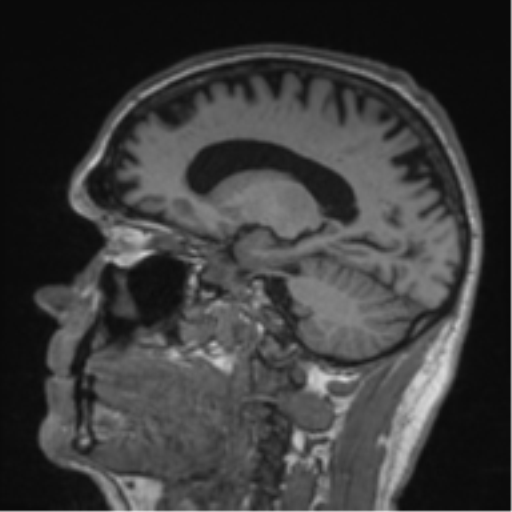 Alzheimer's disease- with Gerstmann syndrome and dressing apraxia (Radiopaedia 54882-61150 Sagittal T1 26).png