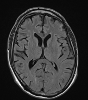 File:Alzheimer's disease- with apraxia (Radiopaedia 54763-61011 Axial FLAIR 15).png