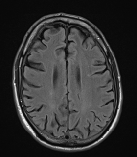 File:Alzheimer's disease- with apraxia (Radiopaedia 54763-61011 Axial FLAIR 19).png