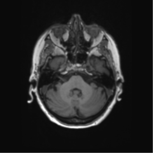 File:Alzheimer's disease (Radiopaedia 42658-45802 Axial T1 116).png