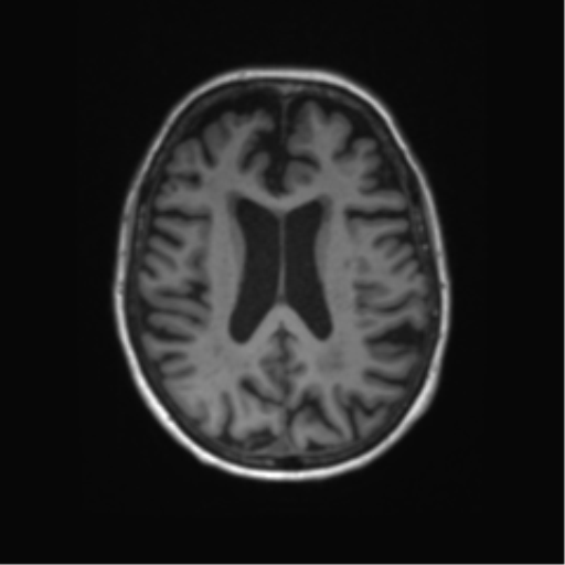 File:Alzheimer's disease (Radiopaedia 42658-45802 Axial T1 64).png