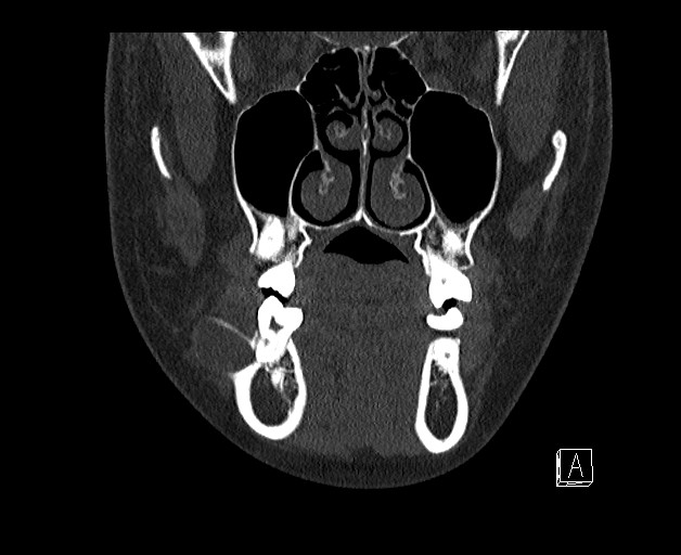 File:Ameloblastoma (Radiopaedia 26645-26793 bone window 1).jpg