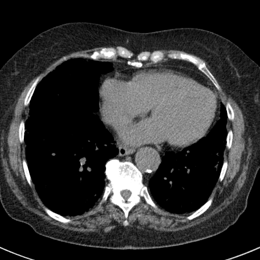 File:Amiodarone-induced pulmonary fibrosis (Radiopaedia 82355-96460 Axial non-contrast 42).jpg