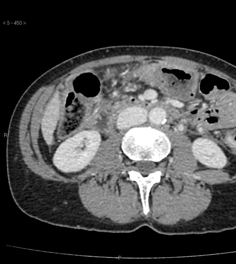 Ampulla of Vater metastasis (Radiopaedia 27820-28065 A 54).jpg