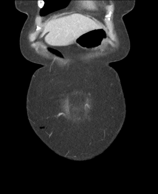 Ampullary adenocarcinoma (Radiopaedia 34013-35237 E 9).png