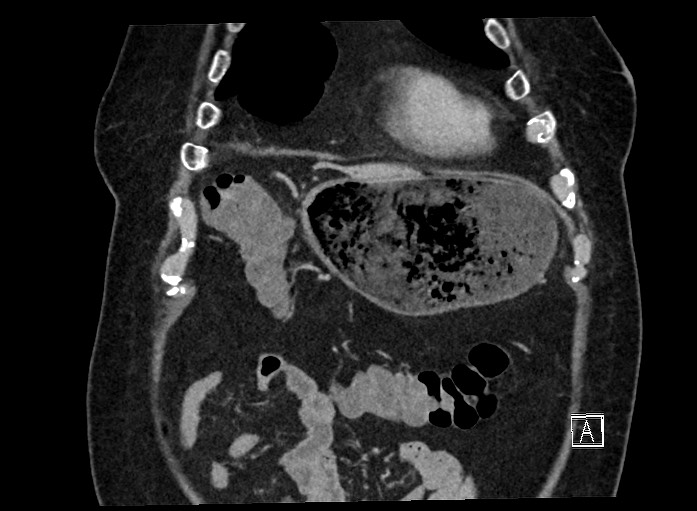Ampullary adenocarcinoma (Radiopaedia 59373-66737 B 17).jpg