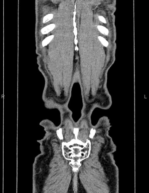 Ampullary adenocarcinoma (Radiopaedia 86093-102032 C 66).jpg