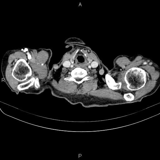 Ampullary adenocarcinoma (Radiopaedia 86093-102033 B 6).jpg