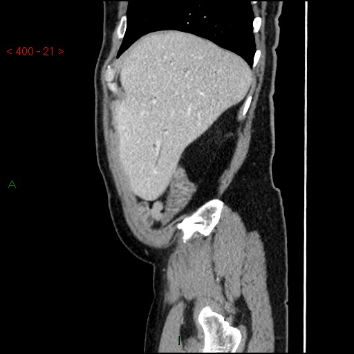 Ampullary carcinoma (Radiopaedia 56396-63056 D 20).jpg