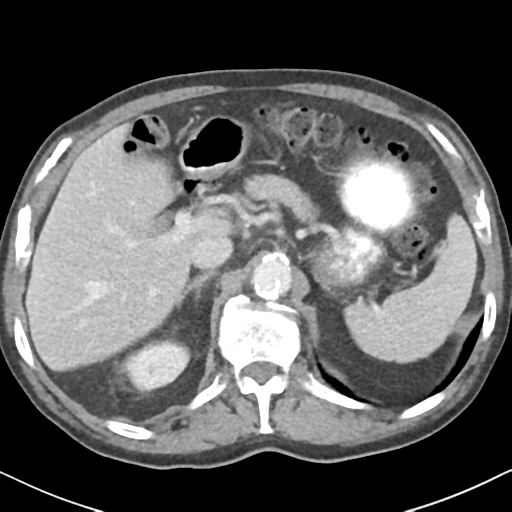 File:Amyand hernia (Radiopaedia 39300-41547 A 16).png