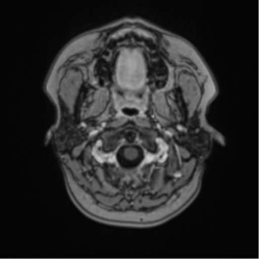 Anaplastic astroblastoma (Radiopaedia 55666-62194 Axial T1 C+ 3).png