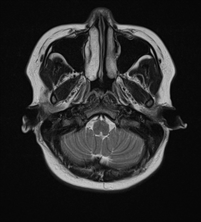 File:Anaplastic astroblastoma (Radiopaedia 55666-62194 Axial T2 4).png