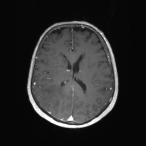 File:Anaplastic astrocytoma (Radiopaedia 86943-103160 Axial T1 C+ 41).png