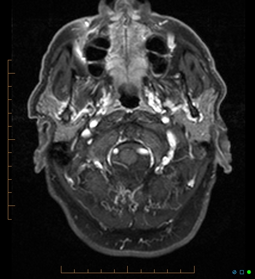 File:Anaplastic astrocytoma (WHO grade III) of the septum pellucidum (Radiopaedia 39365-41633 Axial T1 C+ fat sat 2).jpg