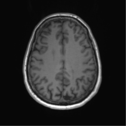 File:Anaplastic astrocytoma - thalamic glioma (Radiopaedia 59709-67115 Axial T1 27).png