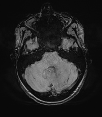 File:Anaplastic astrocytoma IDH mutant (Radiopaedia 50046-55341 Axial SWI 24).png