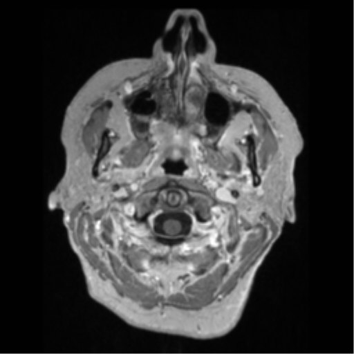 File:Anaplastic astrocytoma IDH wild-type (pseudoprogression) (Radiopaedia 42209-45276 Axial T1 C+ 10).png
