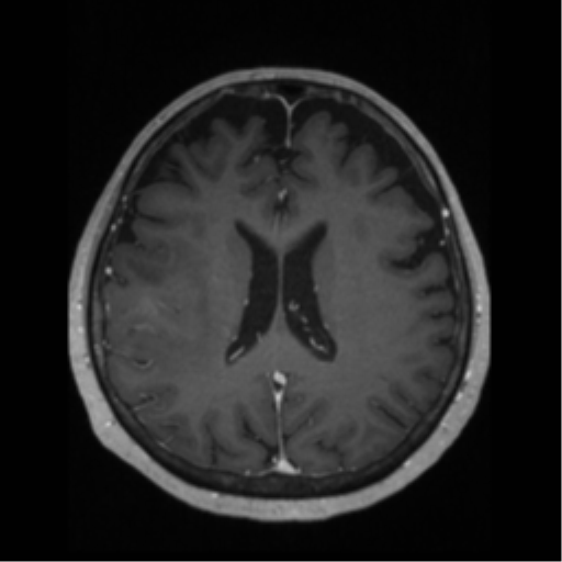 File:Anaplastic astrocytoma IDH wild-type (pseudoprogression) (Radiopaedia 42209-45276 Axial T1 C+ 92).png