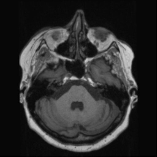 File:Anaplastic astrocytoma IDH wild-type (pseudoprogression) (Radiopaedia 42209-45278 Axial T1 49).png