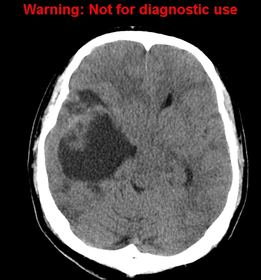 File:Anaplastic ganglioglioma (Radiopaedia 44921-48815 Axial non-contrast 11).jpg