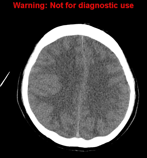 File:Anaplastic ganglioglioma (Radiopaedia 44921-48815 Axial non-contrast 19).jpg