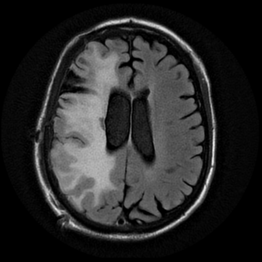 File:Anaplastic meningioma with recurrence (Radiopaedia 34452-35791 Axial FLAIR 14).png