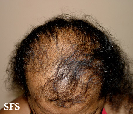 Androgenetic Alopecia (Dermatology Atlas 1).jpg