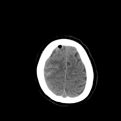 Aneursym related subarachnoid hemorrhage with hydrocephalus (Radiopaedia 45105-49085 Axial non-contrast 44).jpg