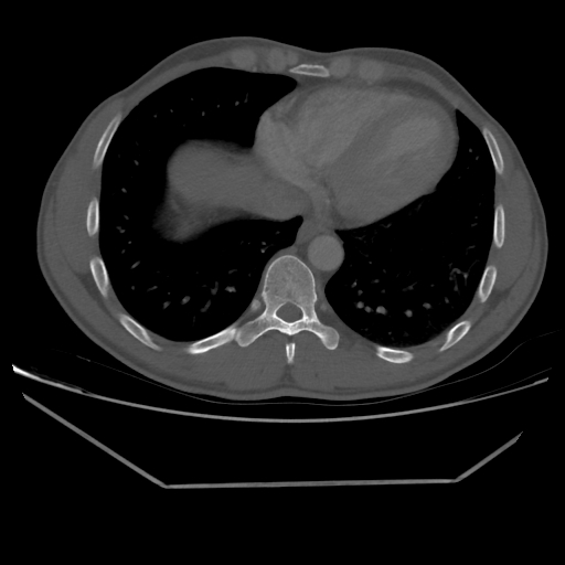 File:Aneurysmal bone cyst - rib (Radiopaedia 82167-96220 Axial bone window 188).jpg