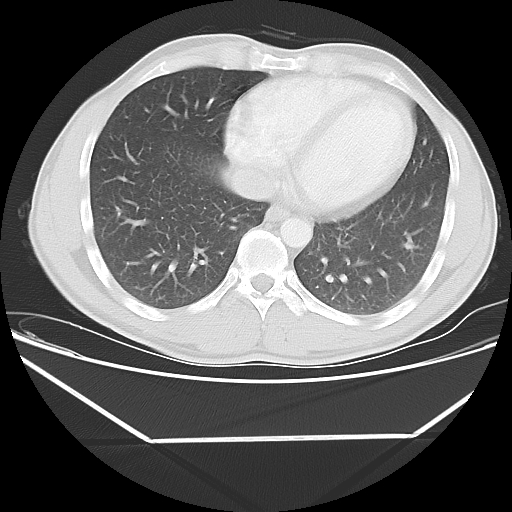 File:Aneurysmal bone cyst - rib (Radiopaedia 82167-96220 Axial lung window 46).jpg