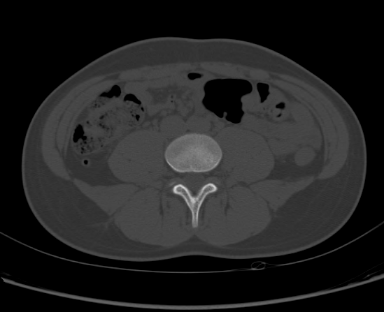 File:Aneurysmal bone cyst of ischium (Radiopaedia 25957-26094 Axial bone window 4).png