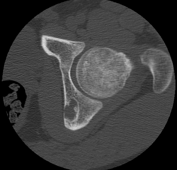 File:Aneurysmal bone cyst of ischium (Radiopaedia 25957-26094 B 14).png