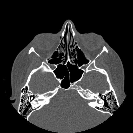 Aneurysmal bone cyst of the mandible (Radiopaedia 43280-46823 Axial bone window 158).jpg