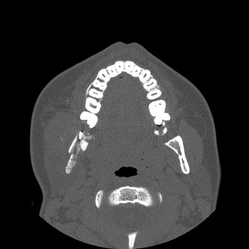 Aneurysmal bone cyst of the mandible (Radiopaedia 43280-46823 Axial bone window 76).jpg