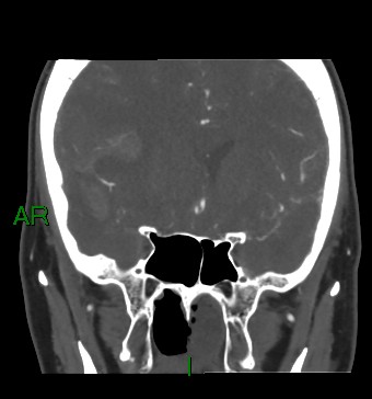 Aneurysmal subarachnoid hemorrhage with intra-axial extension (Radiopaedia 84371-99732 C 64).jpg