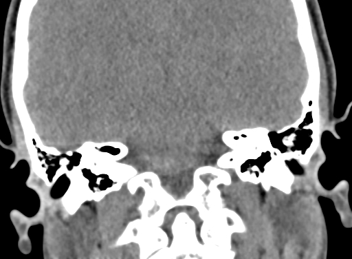 Angular dermoid cyst (Radiopaedia 88967-105790 Coronal non-contrast 78).jpg